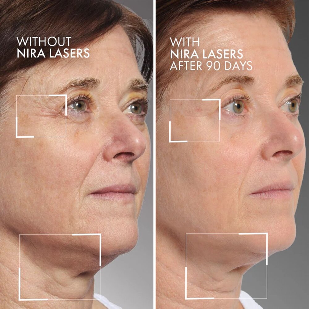 NIRA Pro Skincare Anti-Aging Laser